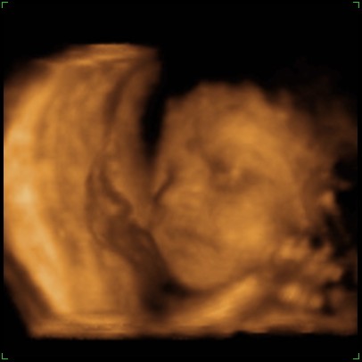 Preivew-ultrasound-pic-cropped-2.jpg