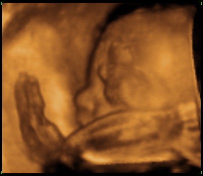 Preivew-ultrasound-pic-cropped-5.jpg