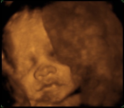 Preivew-ultrasound-pic-cropped.jpg