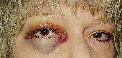 SueAnn-s-black-eye.jpg