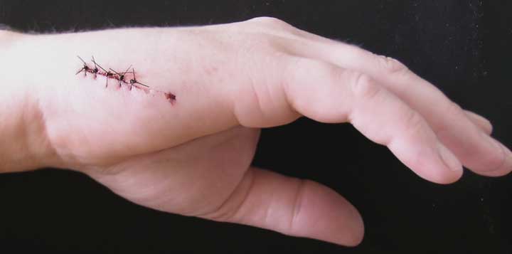 FiveStitchHandWound2.jpg